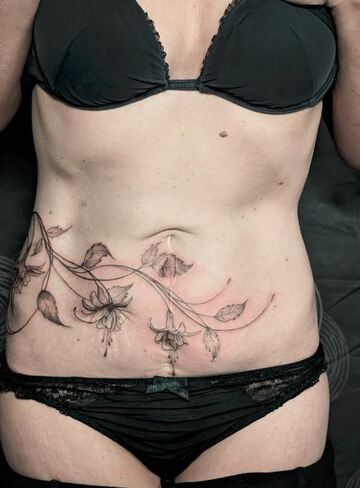 Recouvrement de cicatrices post césarienne 