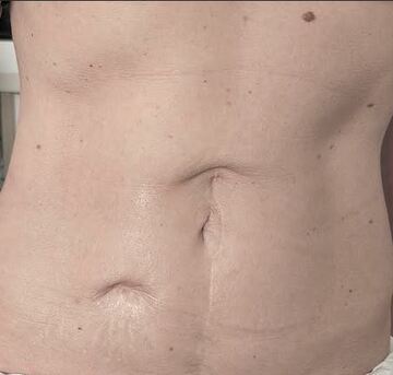 Recouvrement cicatrices