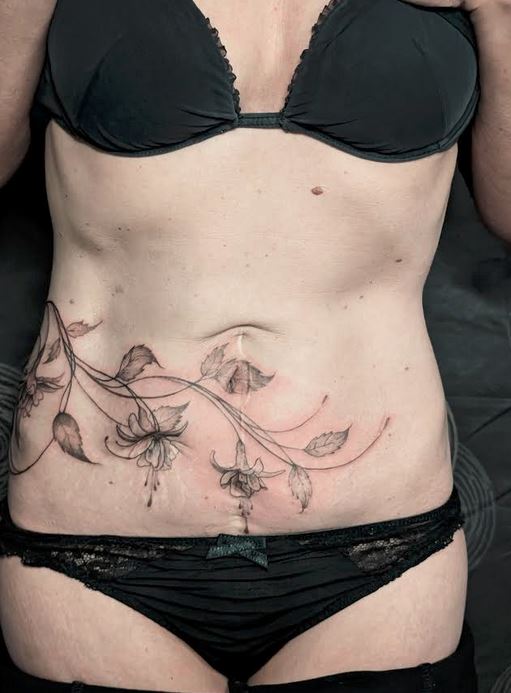 recouvrement cicatrices Recouvrement de cicatrices