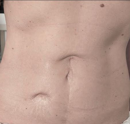 Recouvrement cicatrices